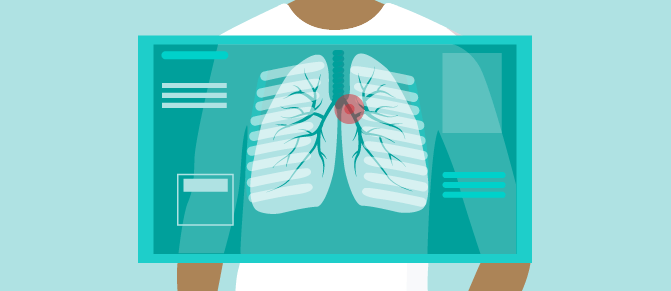 Illustration of an x-ray showing a spot on the lungs