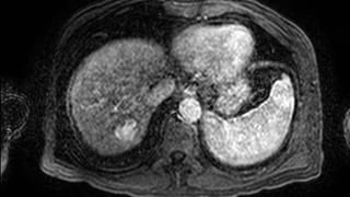 irchemoemboltransarterial1