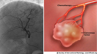 irchemoemboltransarterial2