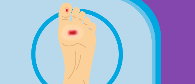 Illustration of diabetic foot ulcer.