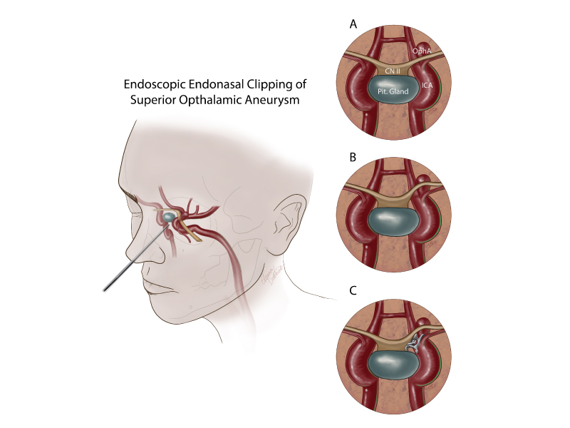 Neurosurgeons at Wellstar MCG Health Medical Center achieved a new surgical approach to treat an aneurysm behind the eye. Believed to be the first of its kind performed through the nose, it’s called endoscopic endonasal clipping of a superior ophthalmic aneurysm.