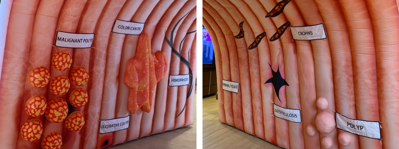 Photo of inflatable colon