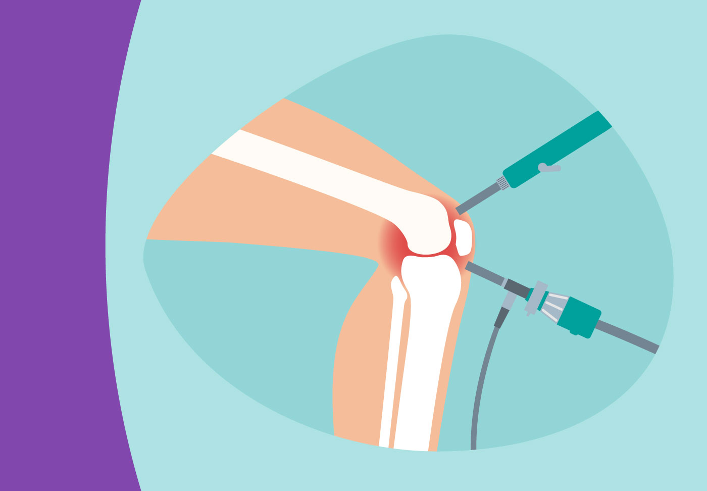 Illustration of knee and surgical tools