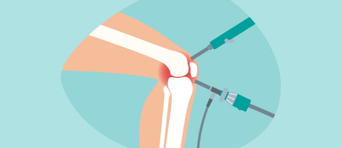 Illustration of knee and surgical tools