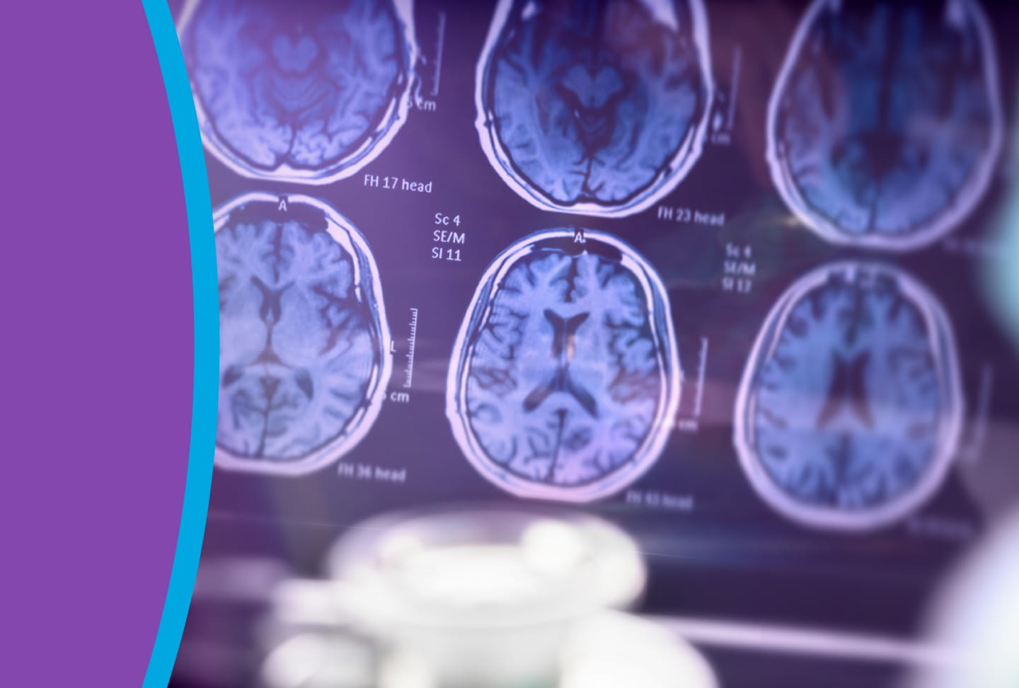 Types of Stroke Image of a brain scan