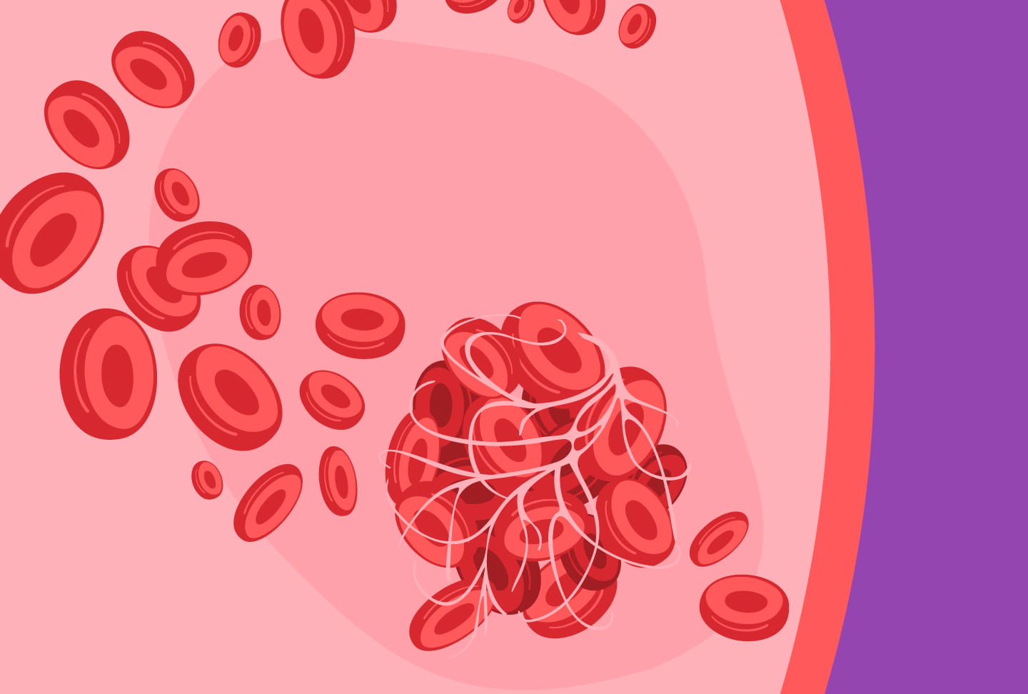 Illustration of blood clot