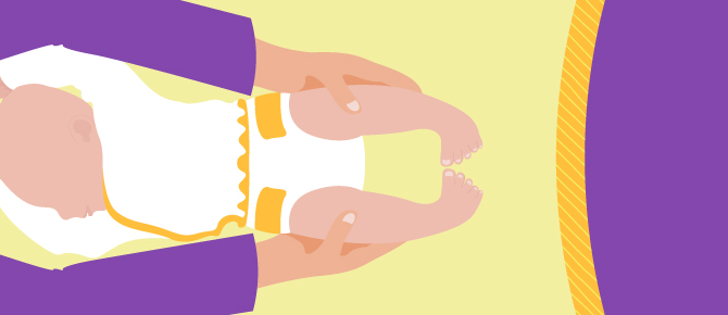 Illustration of provider treating child with clubfoot