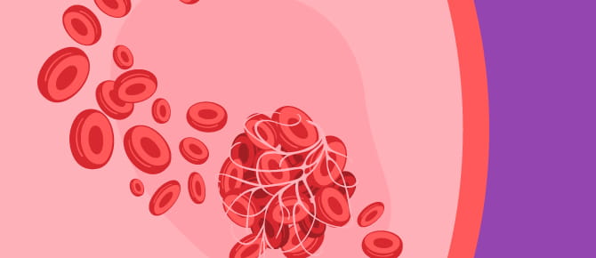 Illustration of blood clot