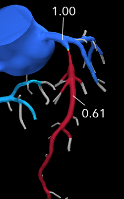 Severe, noncalcific proximal LAD disease which shows significant flow limitation by HeartFlow FFRct analysis (FFRct <0.80).