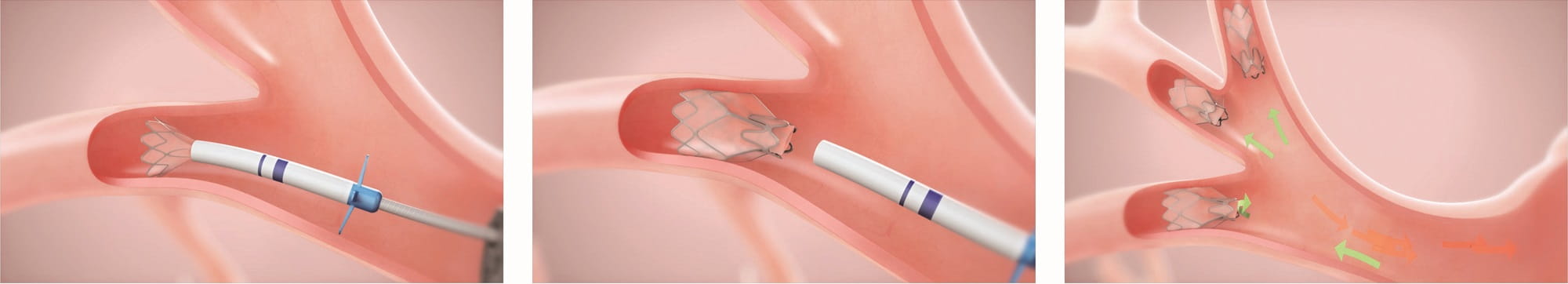 During the minimally invasive procedure, valves are placed inside the lungs using a bronchoscope.
