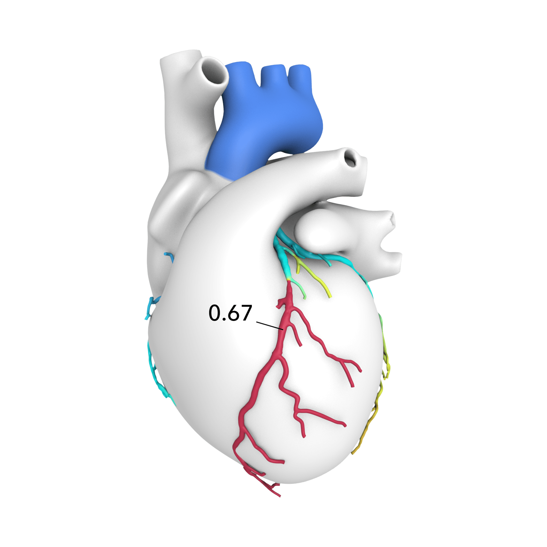 A leading edge technology called HeartFlow Analysis combines CT imaging with powerful computer algorithms to create a personalized, color coded 3D model of coronary arteries. 