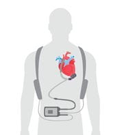 Illustration of HeartMate3 LVAD system worn on the human body.