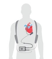 Illustration of HeartMate3 LVAD system worn on the human body. 