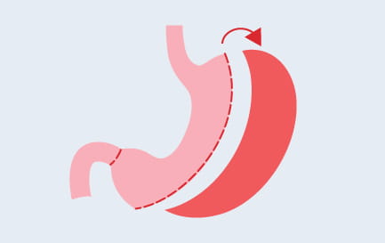 Image of Gastric Sleeve procedure