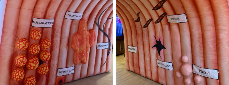 Photo of inflatable colon